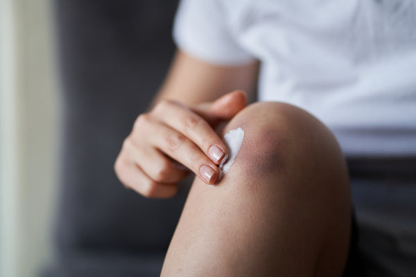 CBD Products for Healing Bruises & How They Work