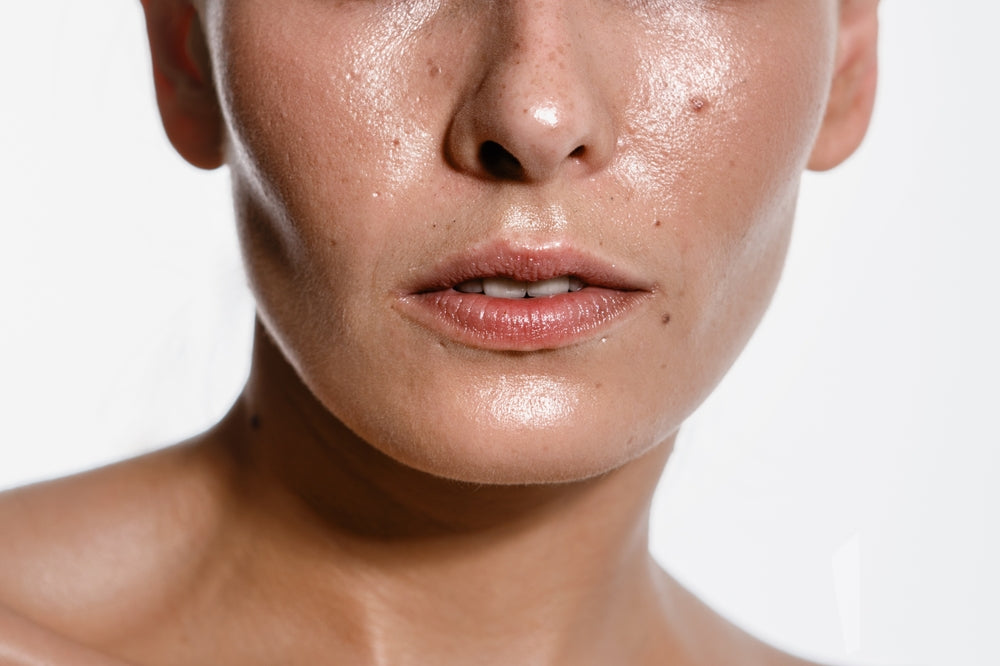 Natural Remedies & Ingredients for Oily Skin