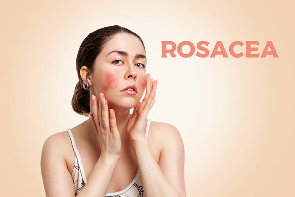 CBD Oil for Rosacea Skincare
