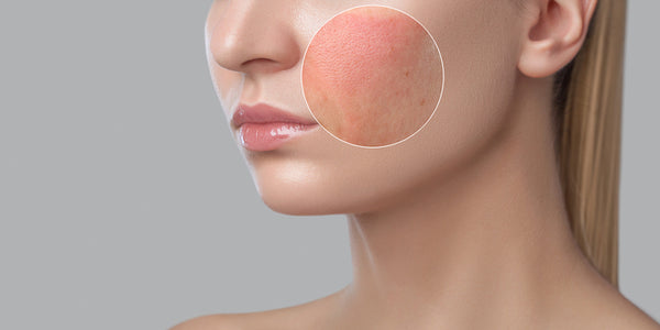 CBD for Skin Inflammation - How it Works